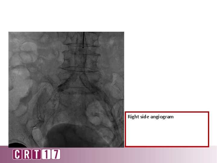 Right side angiogram 