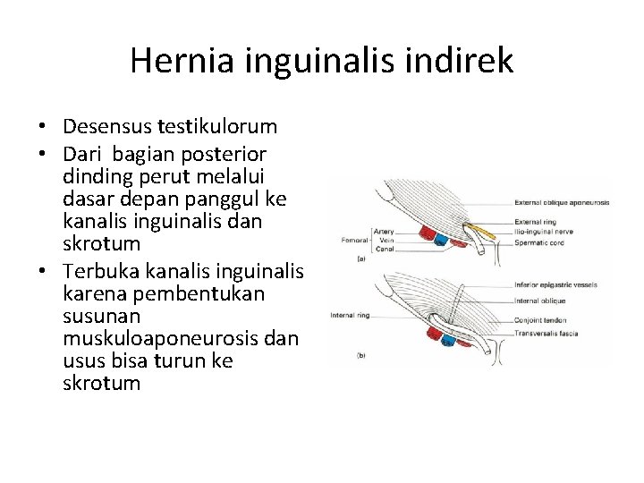 Hernia inguinalis indirek • Desensus testikulorum • Dari bagian posterior dinding perut melalui dasar