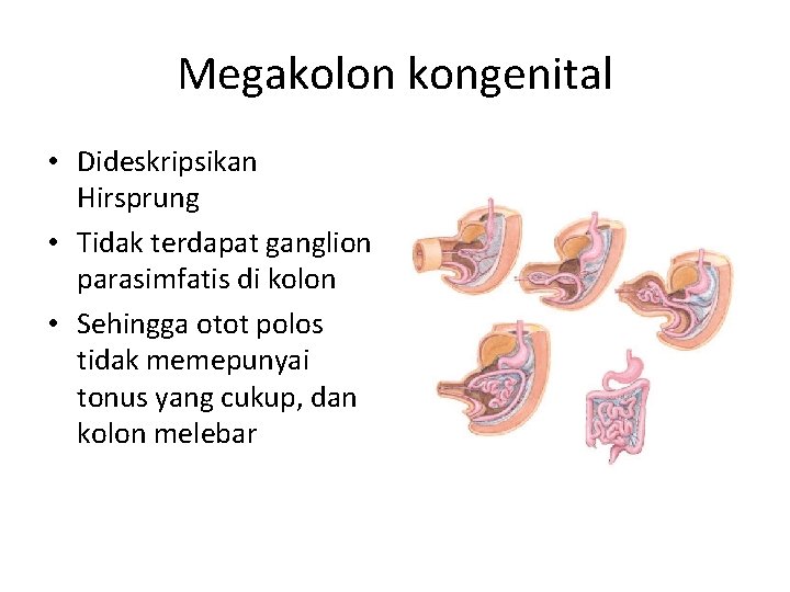 Megakolon kongenital • Dideskripsikan Hirsprung • Tidak terdapat ganglion parasimfatis di kolon • Sehingga