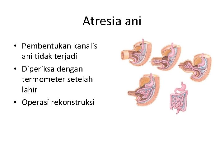 Atresia ani • Pembentukan kanalis ani tidak terjadi • Diperiksa dengan termometer setelah lahir