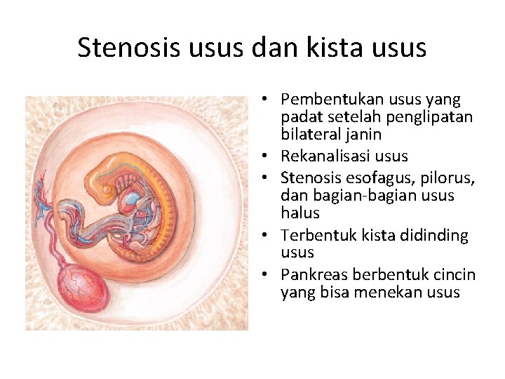 Stenosis usus dan kista usus • Pembentukan usus yang padat setelah penglipatan bilateral janin