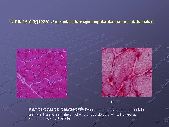 Klinikinė diagnozė: Ūmus inkstų funkcijos nepakankamumas, rabdomiolizė H/E MHC I PATOLOGIJOS DIAGNOZĖ: Raumenų biopsija