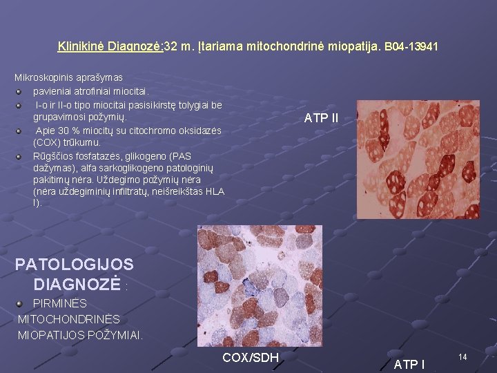 Klinikinė Diagnozė: 32 m. Įtariama mitochondrinė miopatija. B 04 -13941 Mikroskopinis aprašymas pavieniai atrofiniai