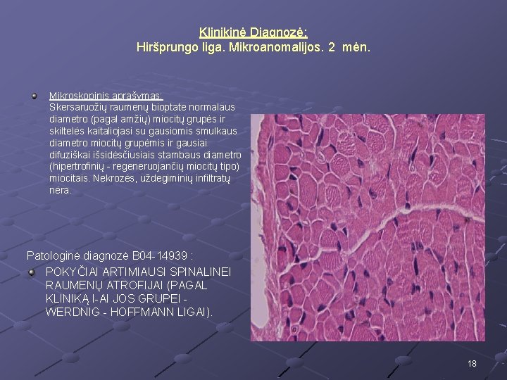 Klinikinė Diagnozė: Hiršprungo liga. Mikroanomalijos. 2 mėn. Mikroskopinis aprašymas: Skersaruožių raumenų bioptate normalaus diametro