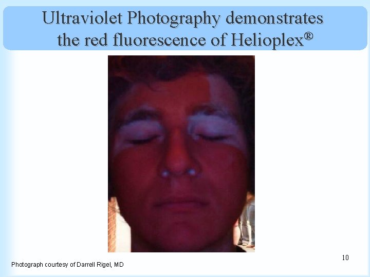 Ultraviolet Photography demonstrates the red fluorescence of Helioplex® Photograph courtesy of Darrell Rigel, MD