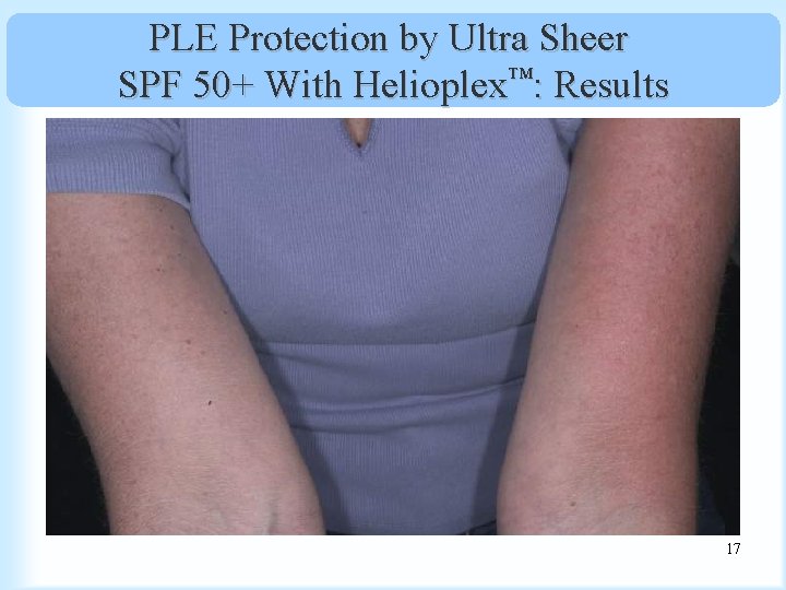 PLE Protection by Ultra Sheer SPF 50+ With Helioplex™: Results 17 