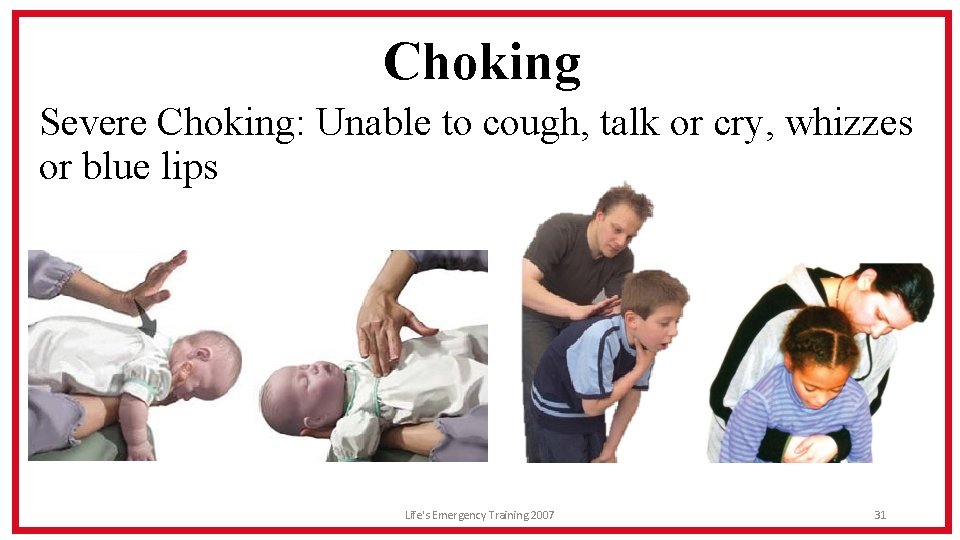 Choking Severe Choking: Unable to cough, talk or cry, whizzes or blue lips Life's