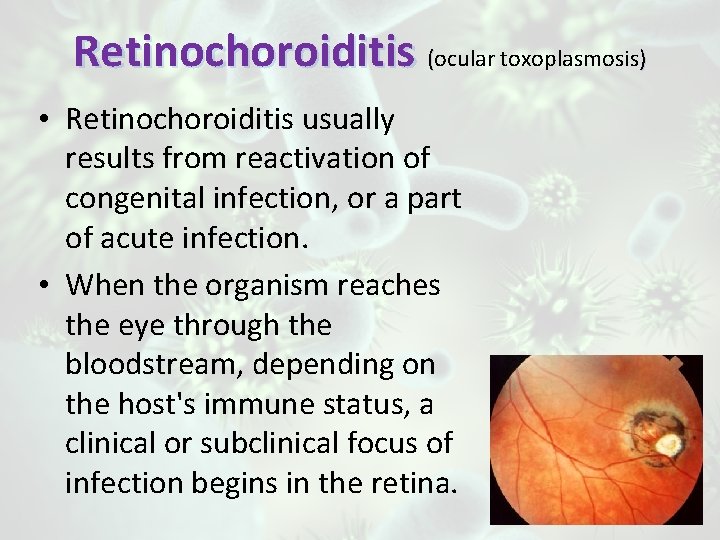 Retinochoroiditis (ocular toxoplasmosis) • Retinochoroiditis usually results from reactivation of congenital infection, or a