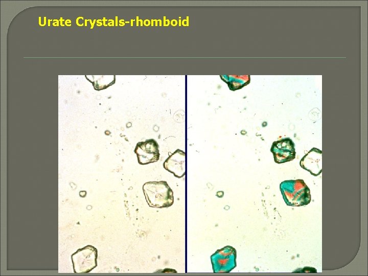 Urate Crystals-rhomboid 