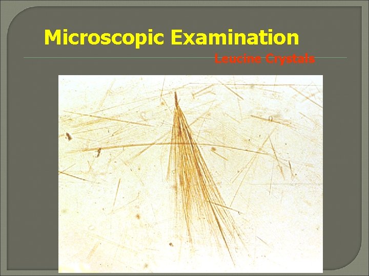 Microscopic Examination Leucine Crystals 