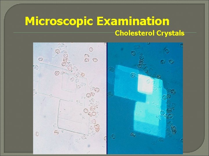 Microscopic Examination Cholesterol Crystals 