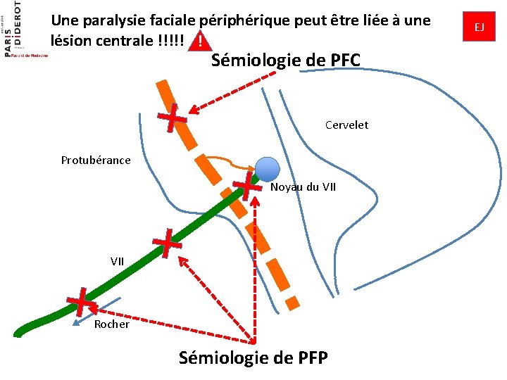 Une paralysie faciale périphérique peut être liée à une lésion centrale !!!!! ! Sémiologie