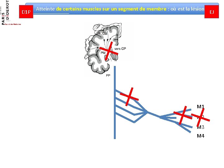 D 1 P Atteinte de certains muscles sur un segment de membre : où