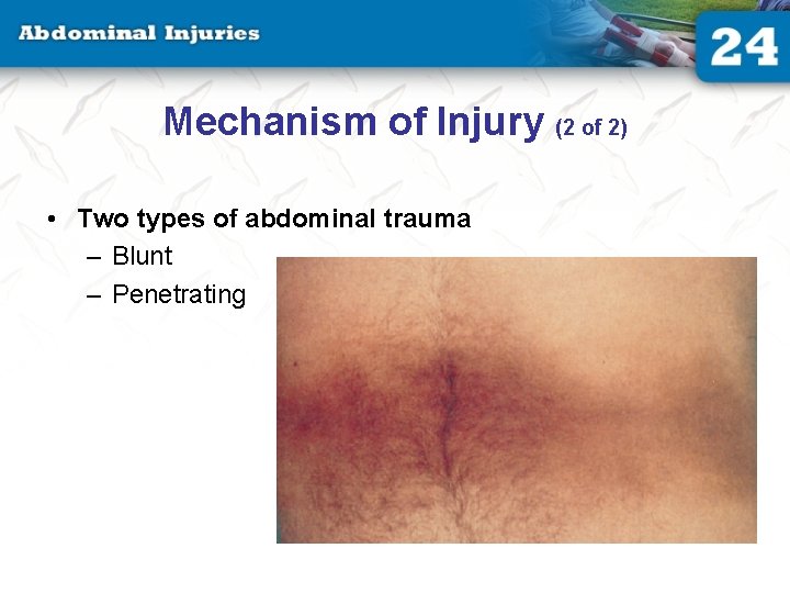 Mechanism of Injury (2 of 2) • Two types of abdominal trauma – Blunt