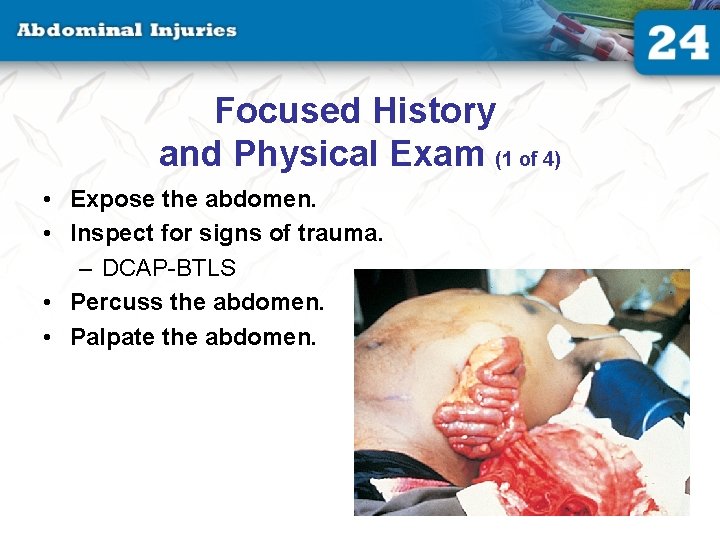 Focused History and Physical Exam (1 of 4) • Expose the abdomen. • Inspect