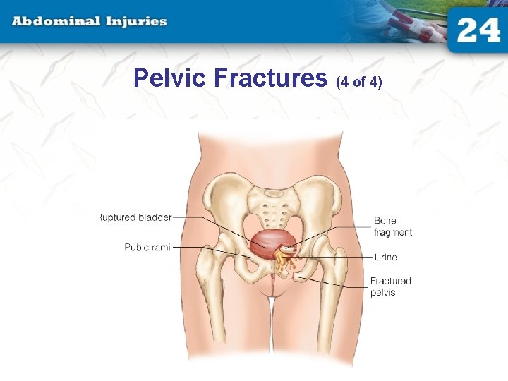 Pelvic Fractures (4 of 4) 