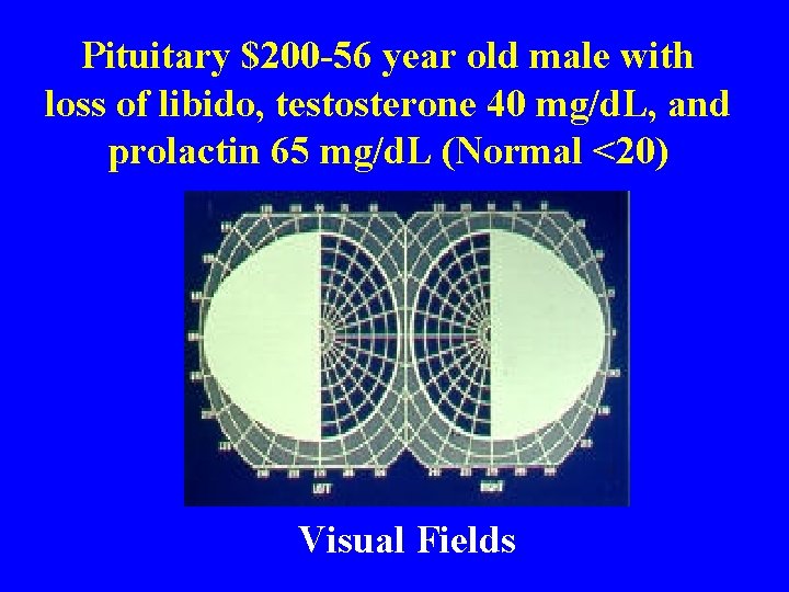 Pituitary $200 -56 year old male with loss of libido, testosterone 40 mg/d. L,