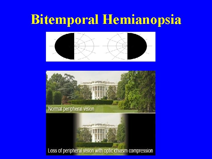 Bitemporal Hemianopsia 