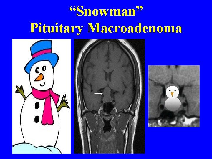 “Snowman” Pituitary Macroadenoma 