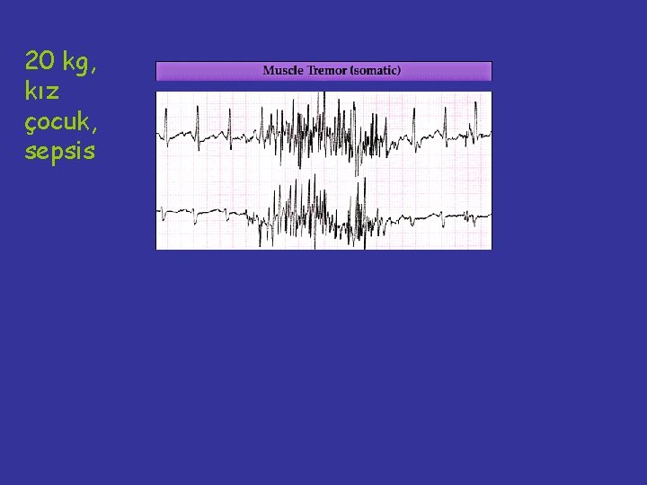 20 kg, kız çocuk, sepsis 