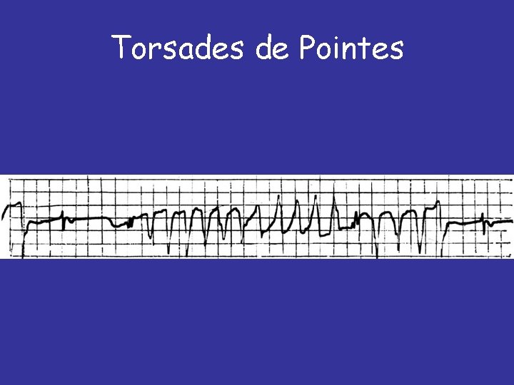 Torsades de Pointes 