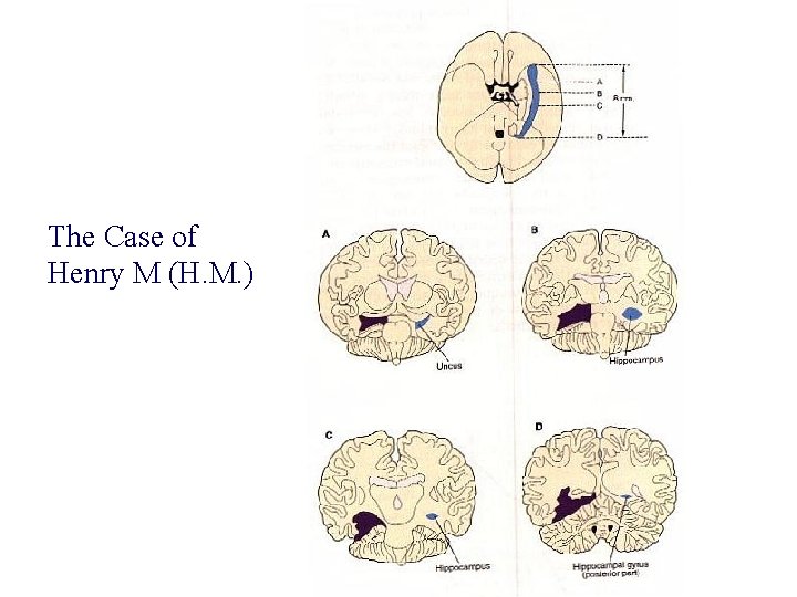 The Case of Henry M (H. M. ) 