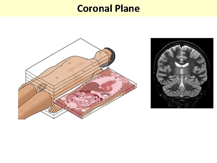 Coronal Plane 