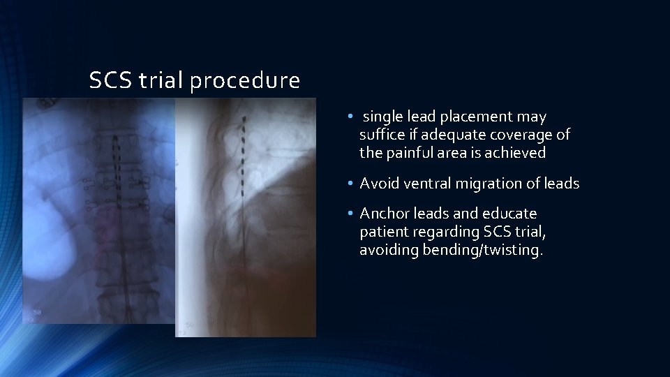 SCS trial procedure • single lead placement may suffice if adequate coverage of the