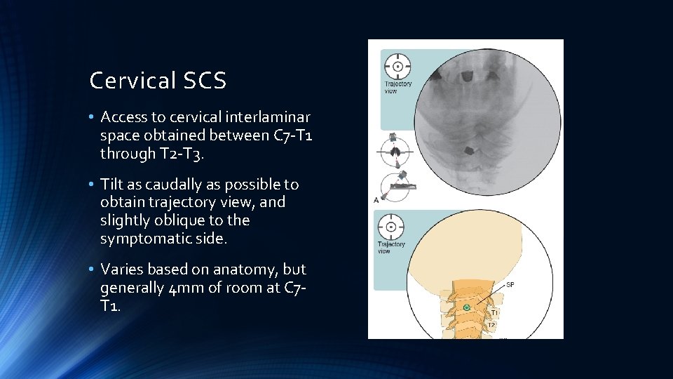 Cervical SCS • Access to cervical interlaminar space obtained between C 7 -T 1