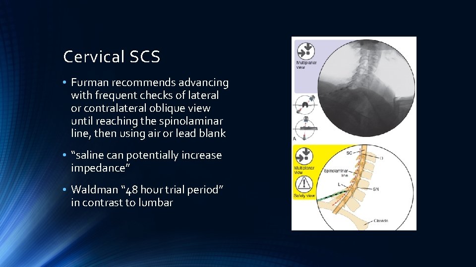 Cervical SCS • Furman recommends advancing with frequent checks of lateral or contralateral oblique