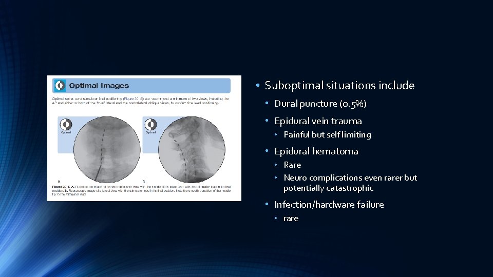  • Suboptimal situations include • Dural puncture (0. 5%) • Epidural vein trauma