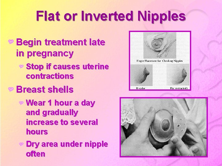 Flat or Inverted Nipples Begin treatment late in pregnancy Stop if causes uterine contractions