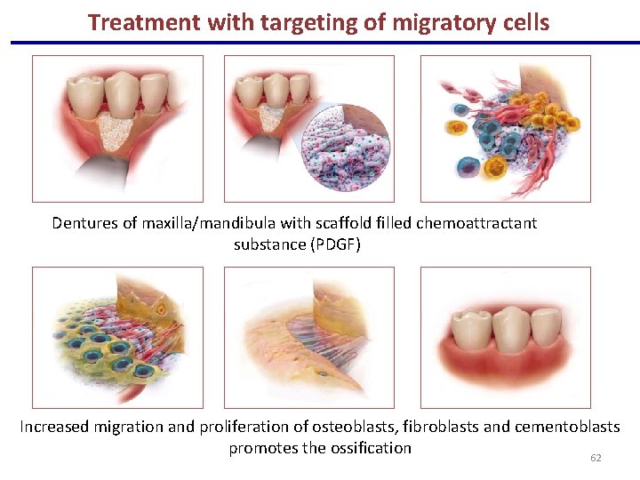 Treatment with targeting of migratory cells Dentures of maxilla/mandibula with scaffold filled chemoattractant substance