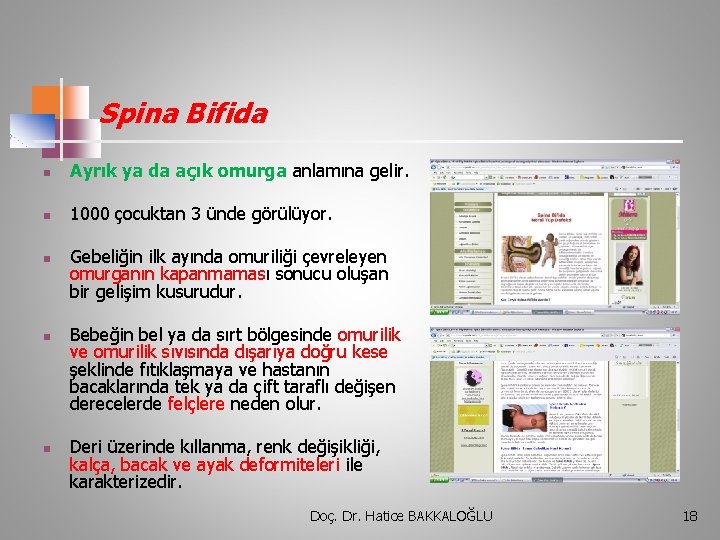 Spina Bifida n Ayrık ya da açık omurga anlamına gelir. n 1000 çocuktan 3