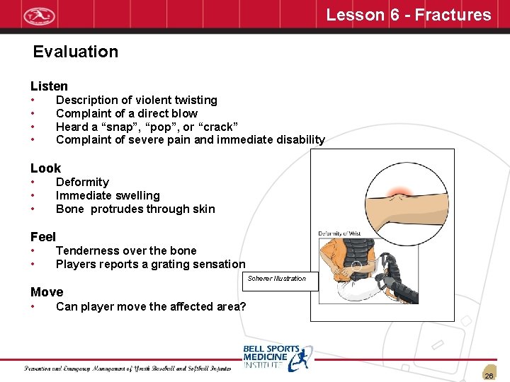Lesson 6 - Fractures Evaluation Listen • • Description of violent twisting Complaint of