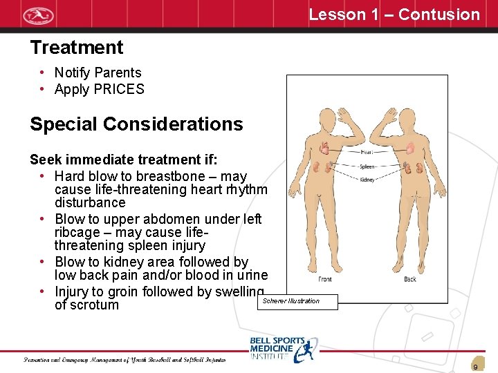 Lesson 1 – Contusion Treatment • Notify Parents • Apply PRICES Special Considerations Seek