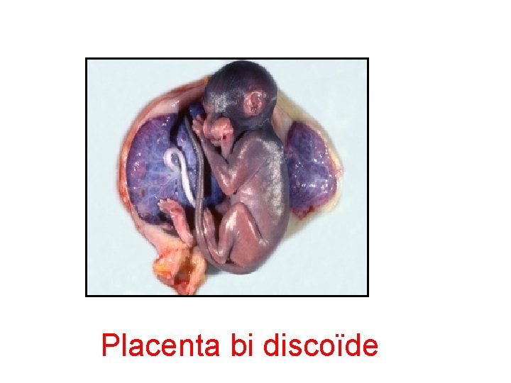 Placenta bi discoïde 