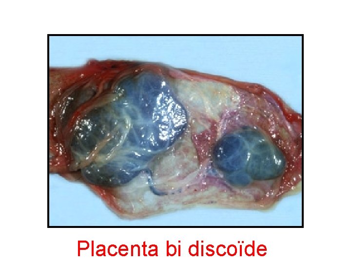 Placenta bi discoïde 