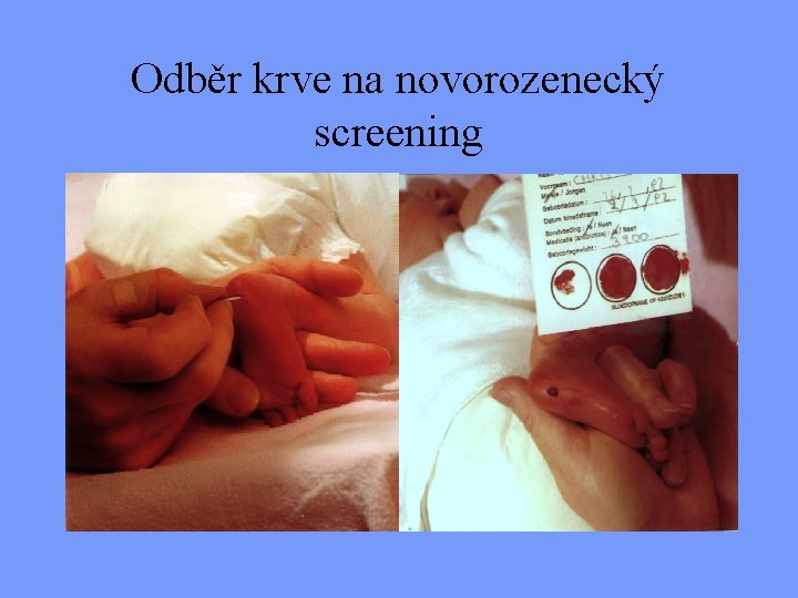Odběr krve na novorozenecký screening 