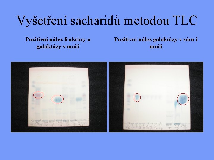 Vyšetření sacharidů metodou TLC Pozitivní nález fruktózy a galaktózy v moči Pozitivní nález galaktózy