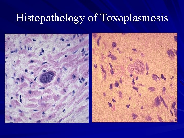 Histopathology of Toxoplasmosis 