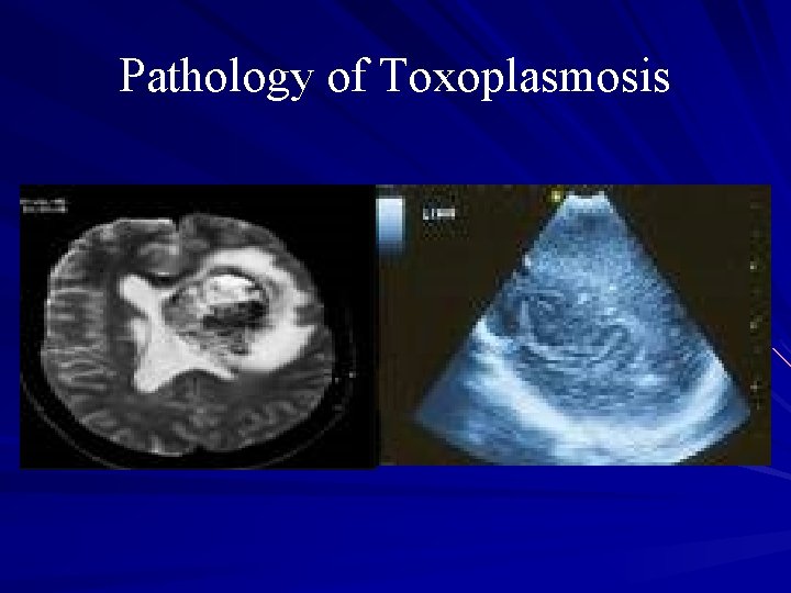 Pathology of Toxoplasmosis 