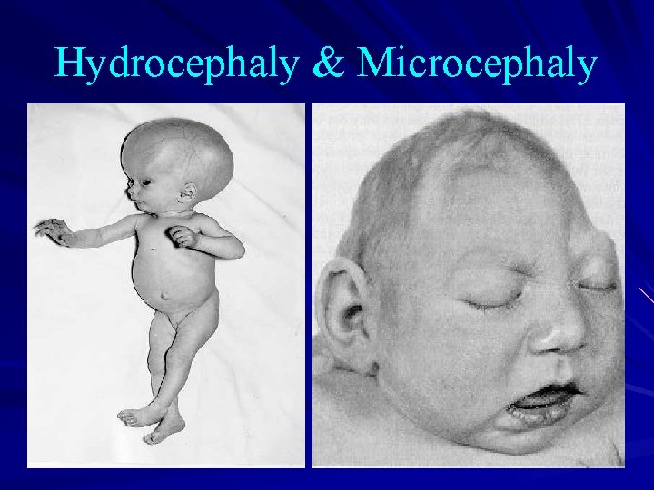 Hydrocephaly & Microcephaly 