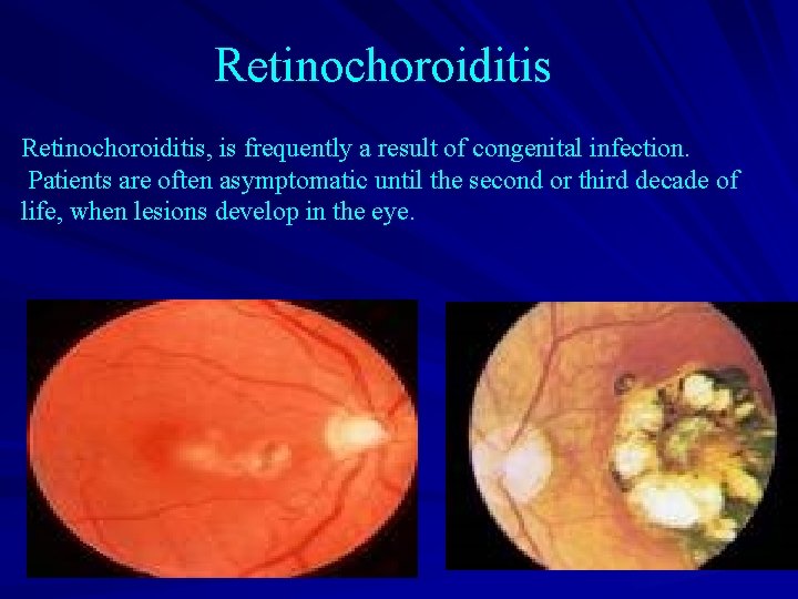 Retinochoroiditis, is frequently a result of congenital infection. Patients are often asymptomatic until the