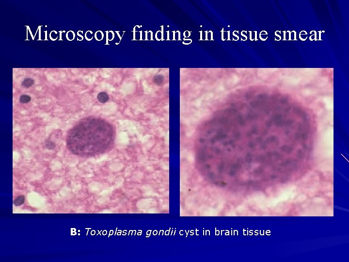 Microscopy finding in tissue smear B: Toxoplasma gondii cyst in brain tissue 