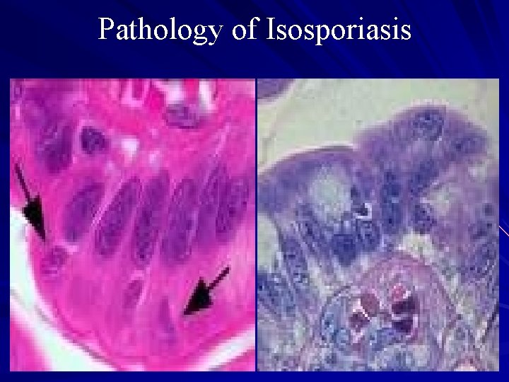 Pathology of Isosporiasis 