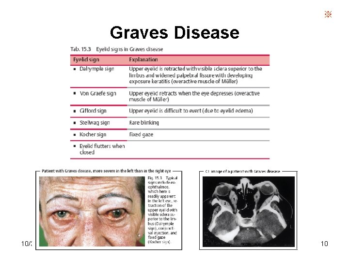 ※ Graves Disease 10/30/2021 10 