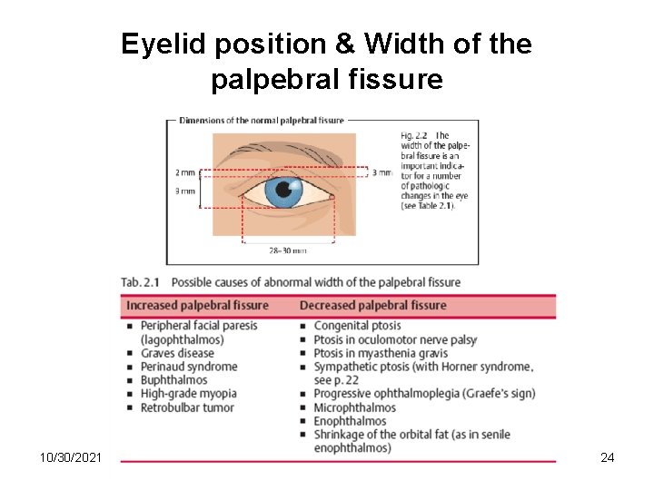 Eyelid position & Width of the palpebral fissure 10/30/2021 24 