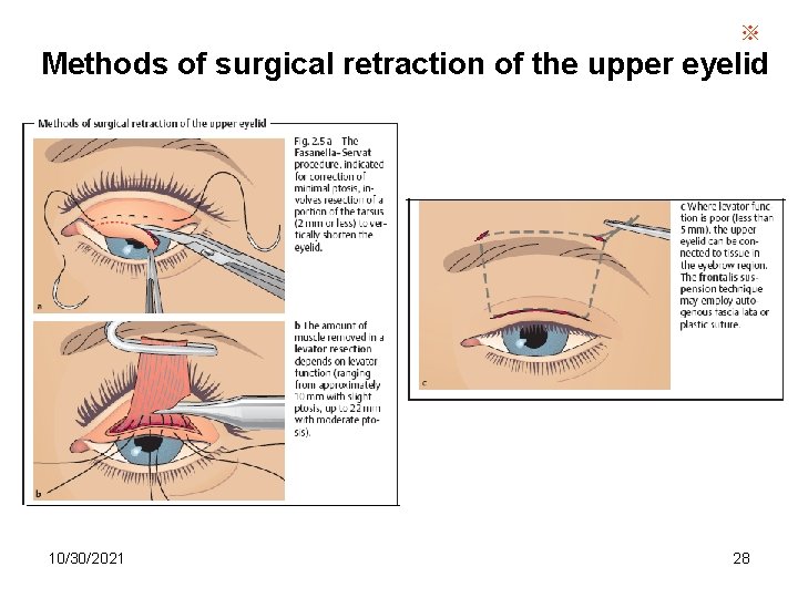 ※ Methods of surgical retraction of the upper eyelid 10/30/2021 28 