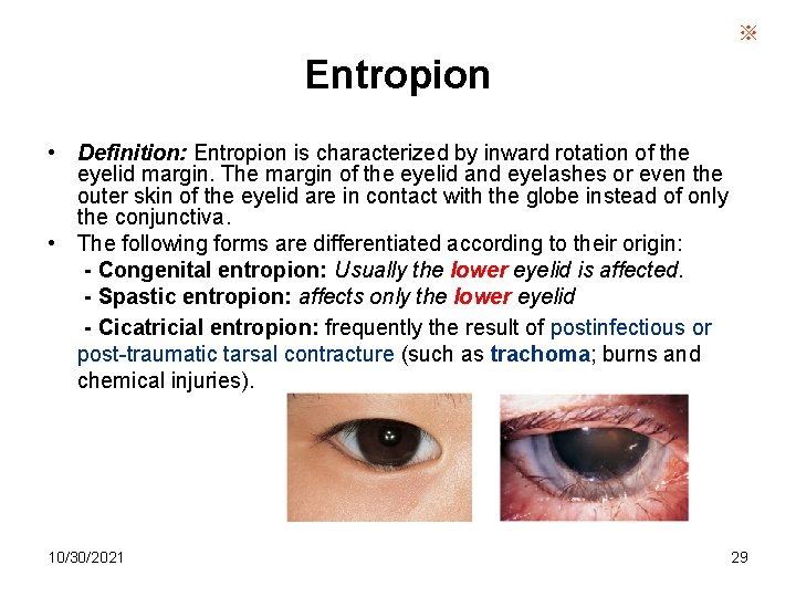 ※ Entropion • Definition: Entropion is characterized by inward rotation of the eyelid margin.